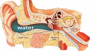 Các triệu chứng của viêm tắc vòi Eustache là gì?
