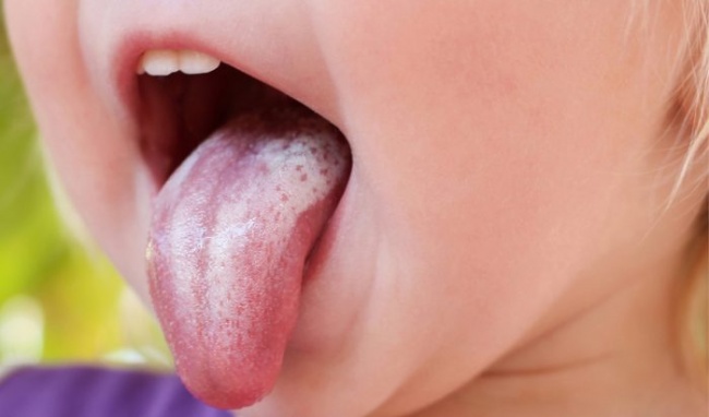 Biện pháp khắc phục nấm miệng (tưa lưỡi) ở trẻ nhỏ | VIAM