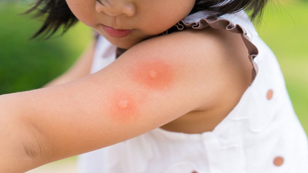 6 mẹo chữa ngứa, giảm sưng khi bị muỗi đốt