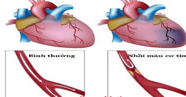 Nhồi máu cơ tim cấp: Dự phòng là quan trọng nhất | VIAM