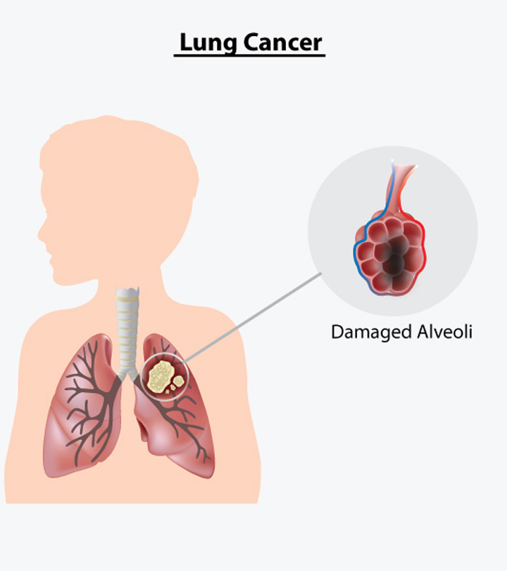 Ung thư phổi có thể xảy ra ở trẻ em hay chỉ xuất hiện ở người lớn?
